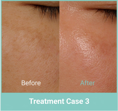 Fat-grafting side-effect treatment case 3 (before and after)
