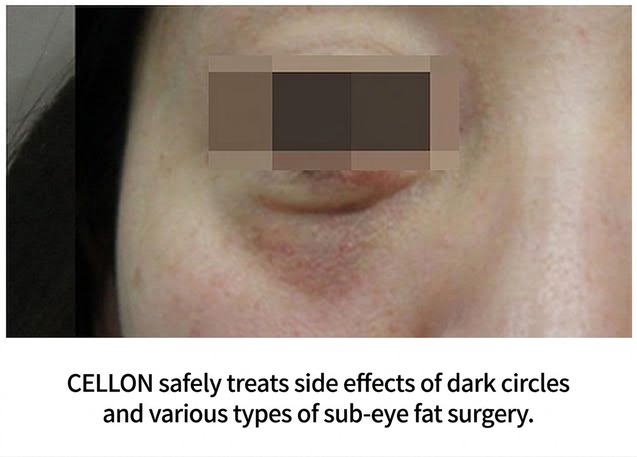Cellon safely treats dark circles and lower-eyelid fat surgery side-effects