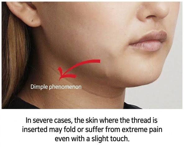 Thread-lift side-effect — dimpling, with skin folding and severe pain in serious cases