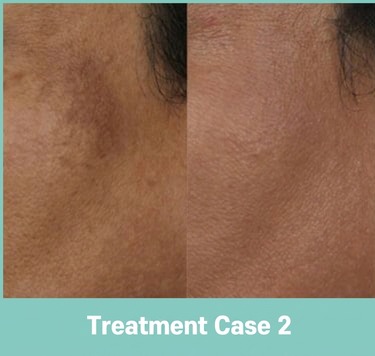 Fat-grafting side-effect treatment case 2 (before and after)