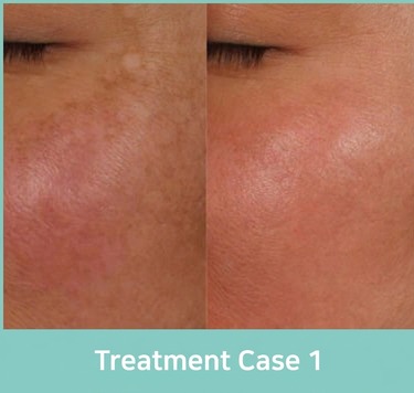 Fat-grafting side-effect treatment case 1 (before and after)