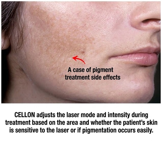 Pigmentation side-effect case — laser mode and intensity adjusted to each skin type