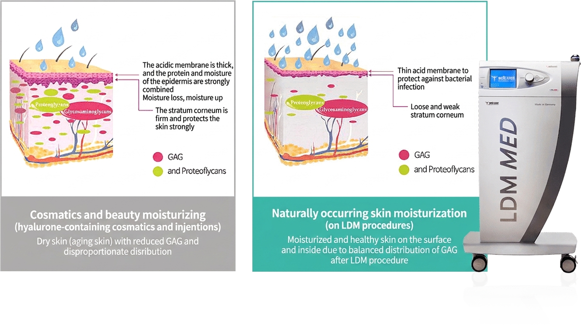 LDM aqua lifting — balanced GAG distribution for hydrated, healthy skin vs dry aged skin