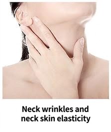 Thermage FLX target area — neck wrinkles and neck skin laxity