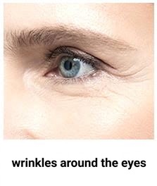 Thermage FLX target area — crow's-feet and under-eye wrinkles