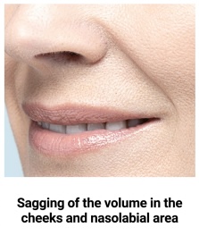 Thermage FLX target area — cheek and nasolabial volume sagging