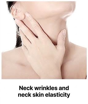Ultherapy Prime target area — neck wrinkles and neck skin laxity