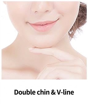 Ultherapy Prime target area — double chin and V-line