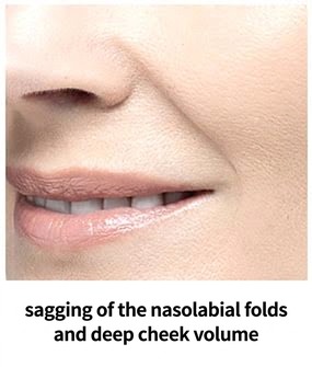 Ultherapy Prime target area — nasolabial folds and deep-cheek sagging
