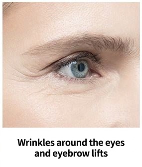 Ultherapy Prime target area — crow's-feet and brow lift