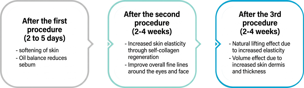 Rejuran results by session — smoother skin, then elasticity, then natural lifting and volume