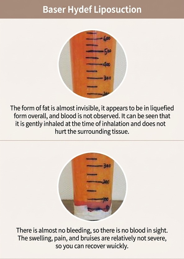 VASER Hi-Def liposuction — liquefied fat with minimal bleeding and fast recovery