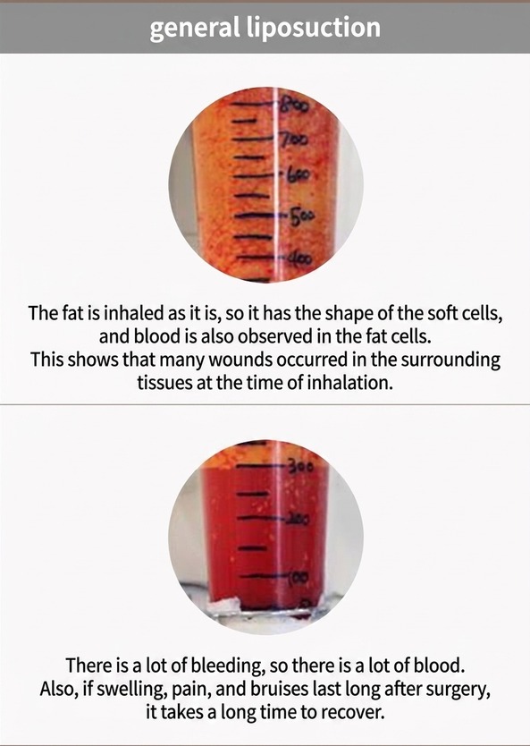 Conventional liposuction — intact fat with blood, more tissue injury and longer recovery