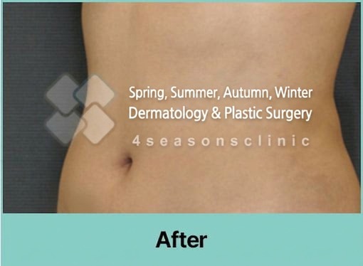 VASER liposuction result — after