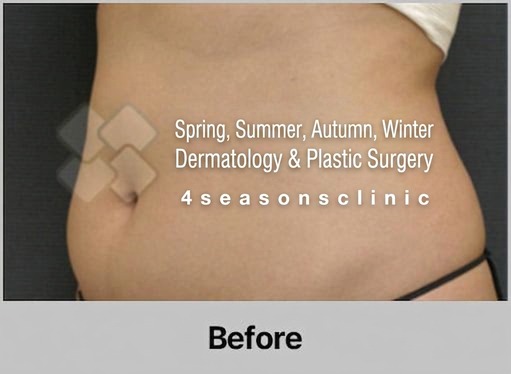 VASER liposuction result — before