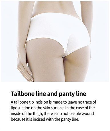 VASER liposuction incision at tailbone and panty line, leaving no visible scar