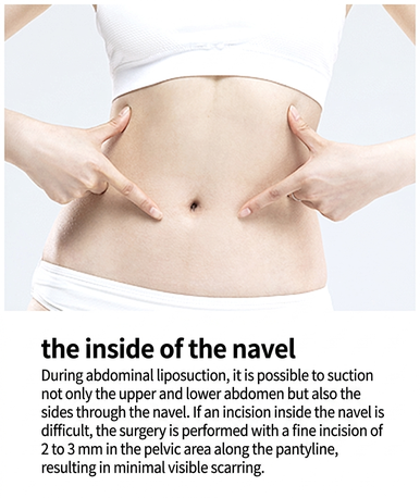 VASER liposuction incision inside the navel, covering abdomen and flanks