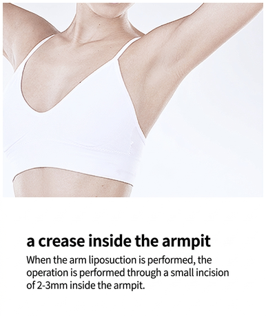 VASER liposuction incision in the inner armpit crease for arm contouring