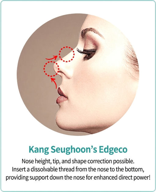 Dr. Kang's Edge Nose — raises and reshapes bridge and tip with absorbable threads