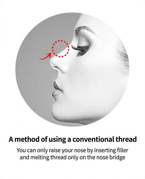 Conventional thread method — raises the nasal bridge only