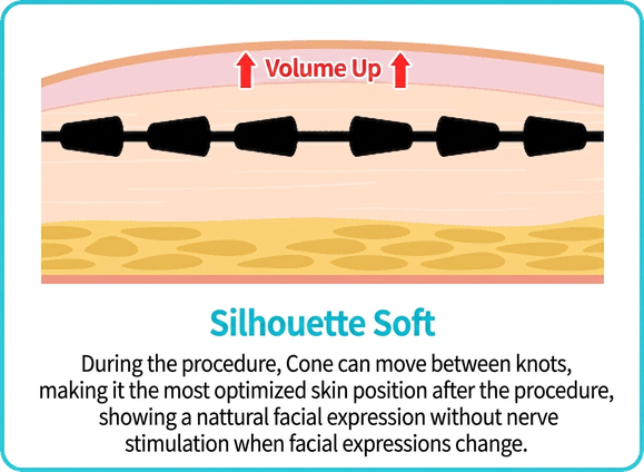 Silhouette Soft — cones move between knots, settling for natural facial expressions