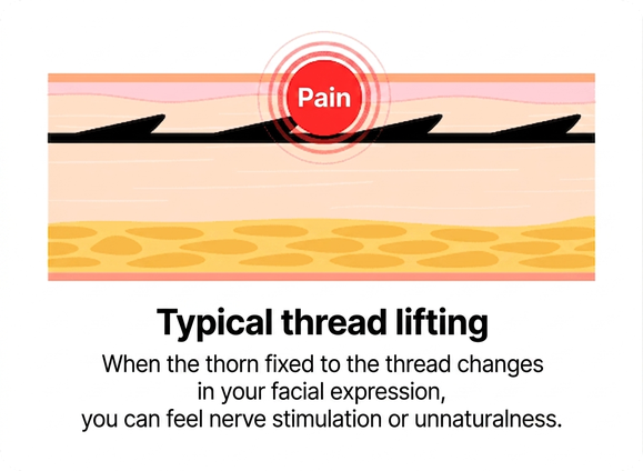 Conventional thread lift — fixed barbs can cause nerve stimulation and pain
