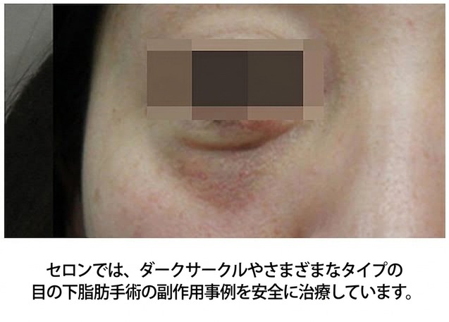 セロンはクマや目の下脂肪手術の副作用を安全に治療