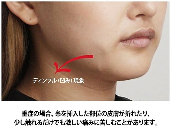 糸リフト副作用 — ディンプル(陥没)、重度では皮膚の折れや激痛