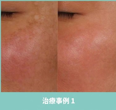 脂肪移植副作用の治療事例1(施術前後)