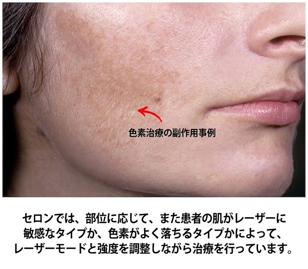 色素副作用の事例 — 肌タイプに応じてレーザーのモード・強度を調整