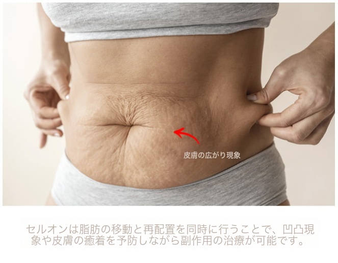 脂肪吸引副作用 — 皮膚のたるみ。脂肪再配置で凹凸を防ぎ治療