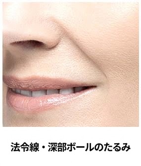 ウルセラプライム対象部位 — ほうれい線・深部頬のたるみ