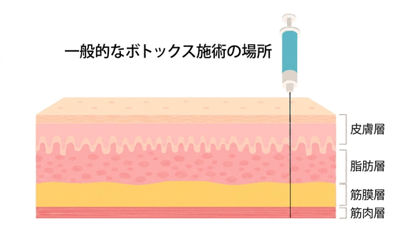 一般ボトックスの施術深度図 — 皮膚層・脂肪層・筋膜層・筋肉層