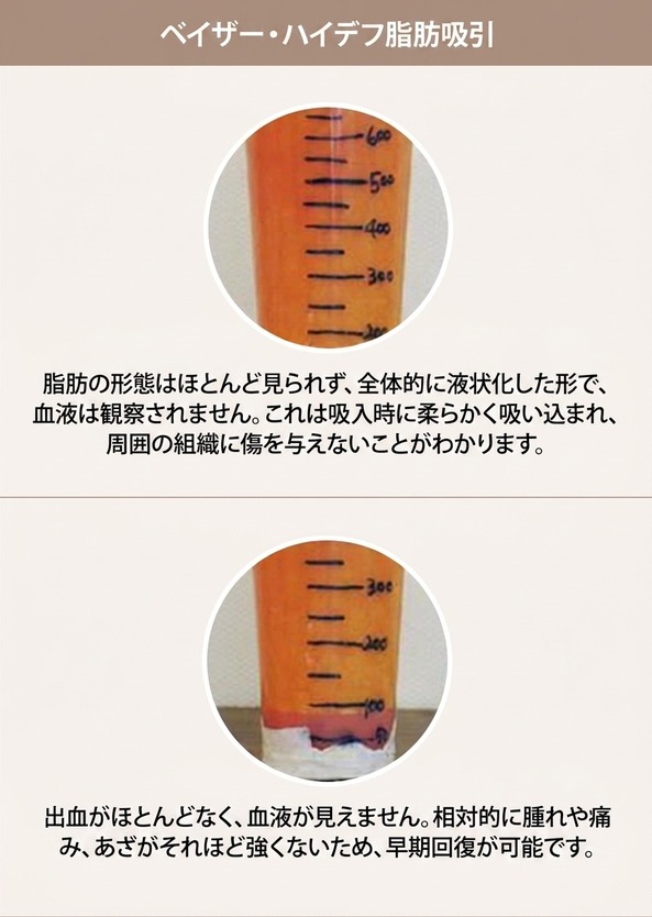 ベイザーハイデフ脂肪吸引 — 液状化した脂肪、出血が少なく回復が早い