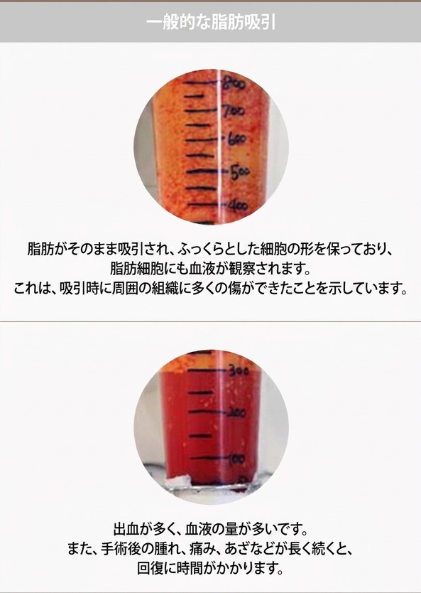 一般脂肪吸引 — 血液を伴う脂肪、周囲組織の損傷が多く回復に時間