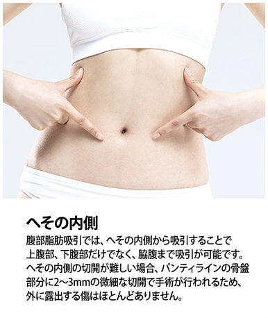 ベイザー脂肪吸引の切開 — へその内側で腹部・脇腹まで対応