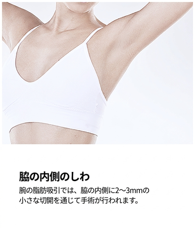 ベイザー脂肪吸引の切開 — 脇の内側で腕の輪郭形成