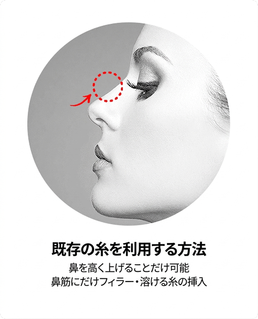 従来の糸を用いる方法 — 鼻筋の高さのみ