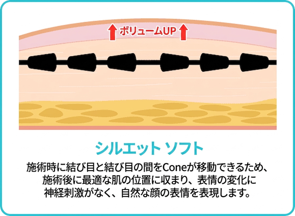 シルエットソフト — Coneが結び目間を移動し自然な表情に