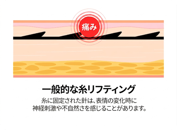 一般的な糸リフト — 固定されたトゲが神経刺激や痛みの原因に