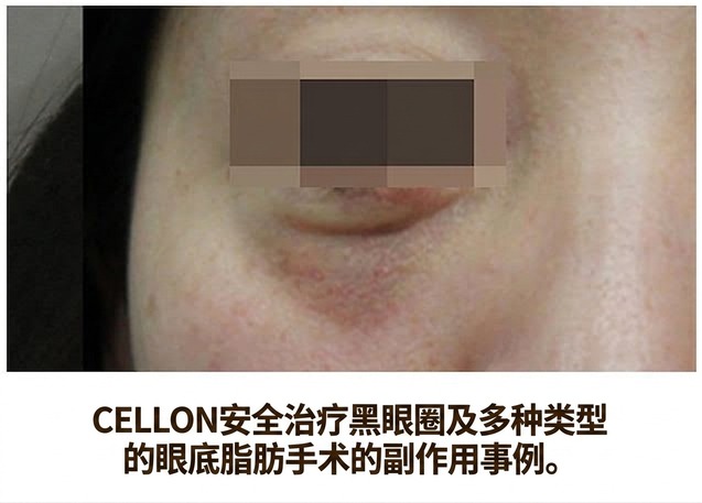赛隆安全治疗黑眼圈及下眼睑脂肪手术副作用