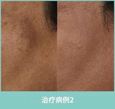 脂肪移植副作用治疗案例2(治疗前后)