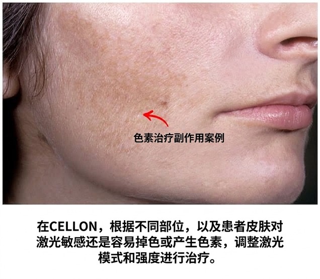 色素副作用案例 — 依肤质调整激光模式与强度