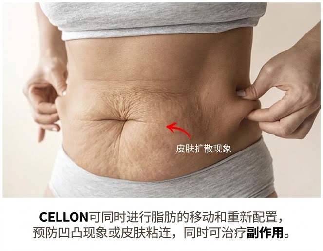 吸脂副作用 — 皮肤松弛;通过脂肪重置预防凹凸