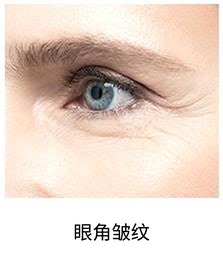 热玛吉FLX适用部位 — 眼角与眼下细纹