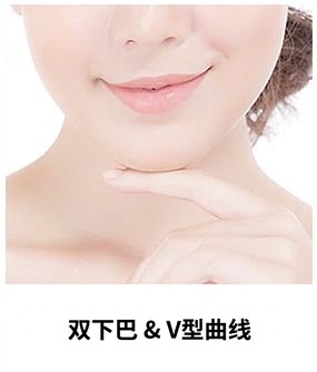 Ultherapy Prime适用部位 — 双下巴与V线