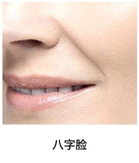 Ultherapy Prime适用部位 — 法令纹与深层面颊下垂