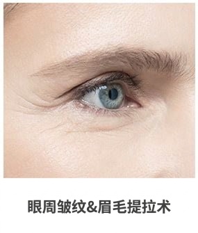 Ultherapy Prime适用部位 — 眼角细纹与眉部提升