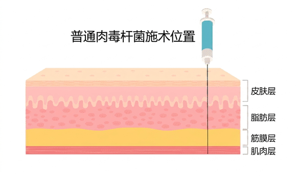 普通肉毒注射深度示意 — 表皮层·脂肪层·筋膜层·肌肉层