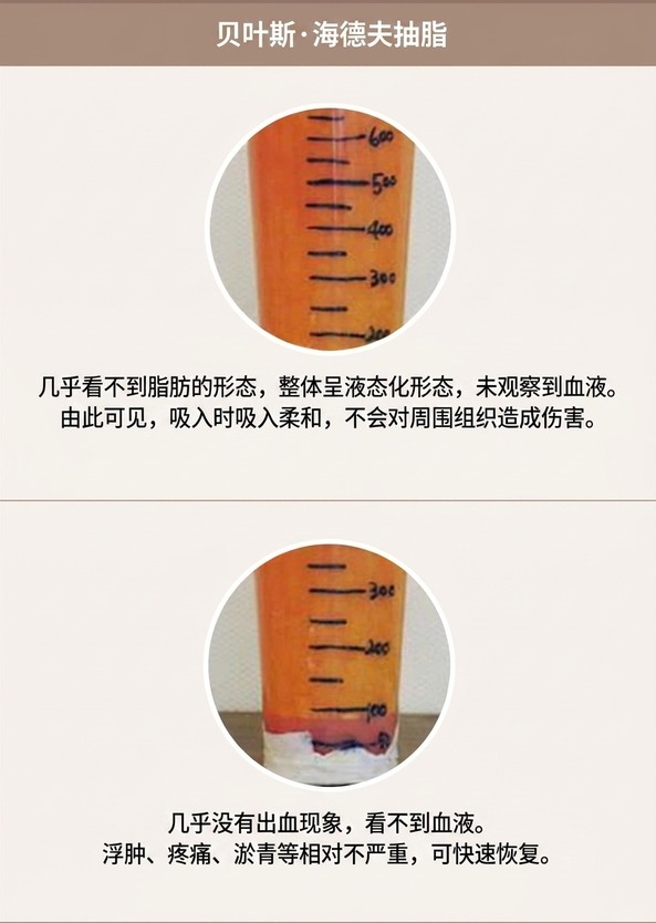 威塑Hi-Def吸脂 — 脂肪液化、出血少、恢复快